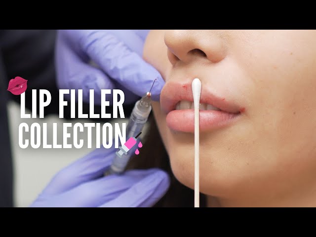 Lip Filler Time Lapse Collection! 💋💉