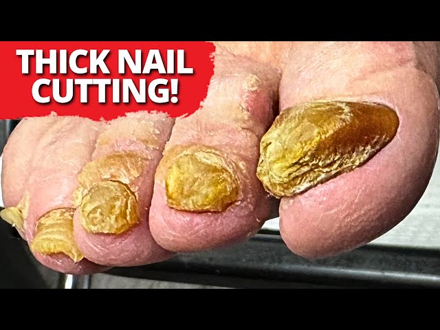 Cutting Thick Yellow Toenails – You Won’t Believe the Before and After!