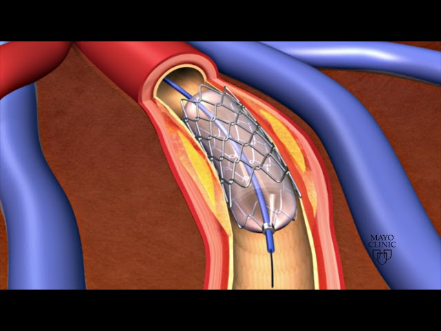 Animation - Coronary stent placement