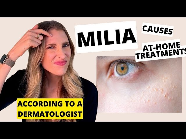 Milia: Causes, At-Home Skincare Treatments, & Prevention | Dr. Sam Ellis