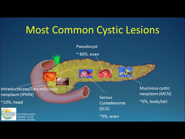 Natural History of Pancreatic Cysts: What Becomes of Them?