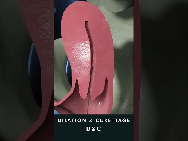 Dilation and Curettage D&C animation #uterinecancer #treatment