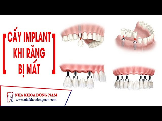 [ƯU ĐIỂM] Cấy Ghép Răng Implant khi bị mất răng | NHA KHOA ĐÔNG NAM®