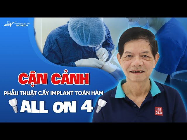 [CẬN CẢNH] phẫu thuật cắm implant hàm trên cho khách hàng trồng implant toàn hai hàm.