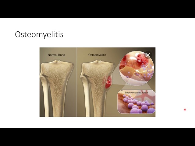 Osteomyelitis