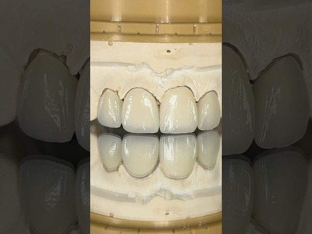 Kosmic Press Layered Veneers and Crown #lsk121shorts #dentist #teeth