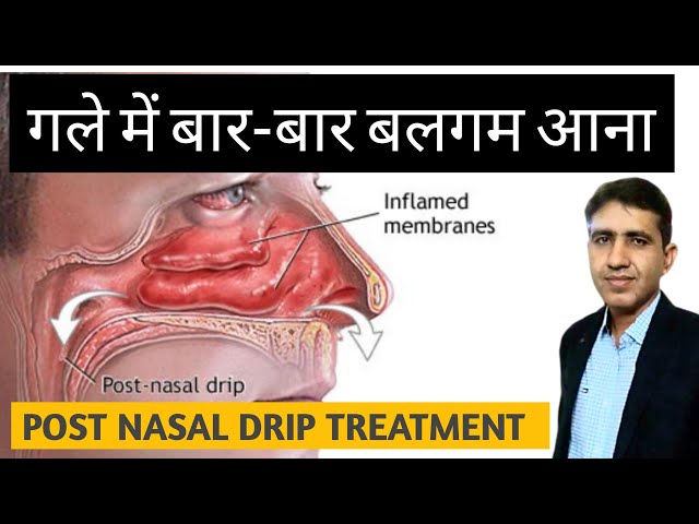 PND | Post Nasal Drip Treatment | गले में बार -बार बलगम आना | Homeopathic Treatment For PND