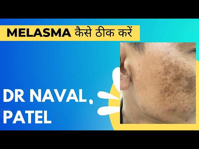 Melasma kaise thik kare #melasma #facepigmentation