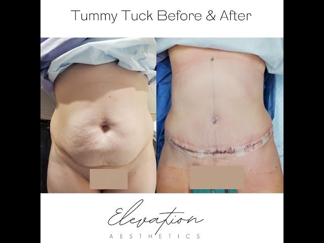 Tummy Tuck | Liposuction | Dr. Joseph Jensen, DO FACOS | Utah Surgeon