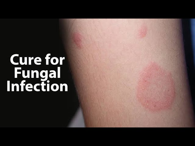 Fungal infection treatment without medicine