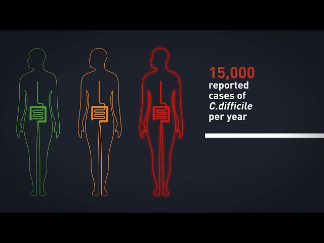 Faecal Microbiota Transplants (FMT) for treatment of serious infection