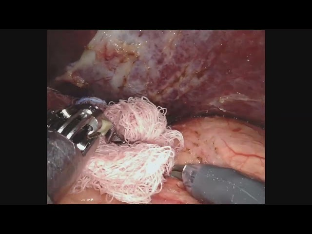 Robotic Right Adrenalectomy