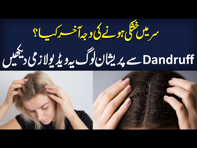 Dandruff Ki Wajah? | Dandruff Treatment at Home | Health Matters