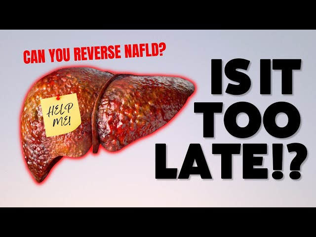 NAFLD: How to Treat and Reverse Non-Alcoholic Fatty Liver Disease