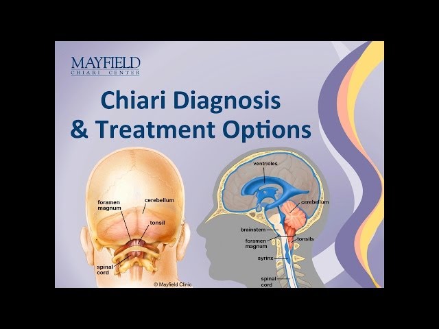 Chiari Malformation Diagnosis & Treatment Options