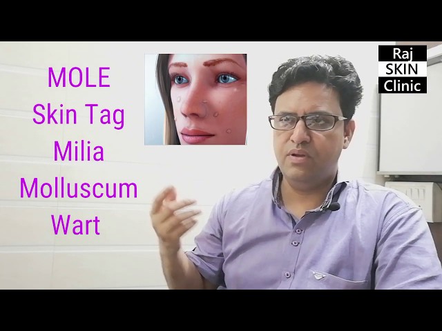 How to treat: Wart | Mole | Skin Tag | Milia | Molluscum | Skin Cancer: Dr. Rajeev Srivastav