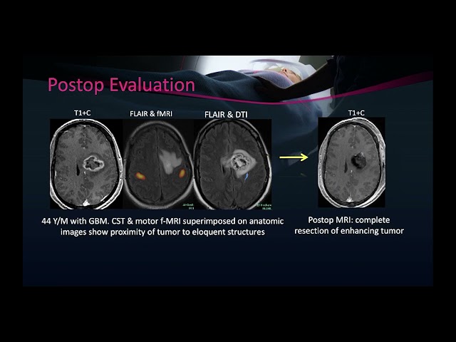 Imaging of High grade glioma