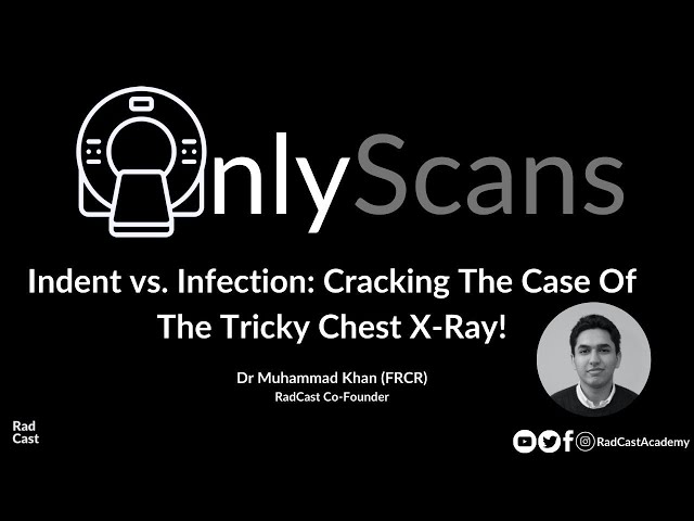 OnlyScans Radiology Review: Indent vs. Infection - Cracking The Case Of The Tricky Chest X-Ray!