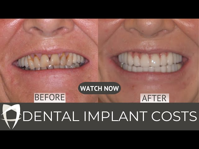 Dental Implant Costs in London: Shocking Truth Revealed