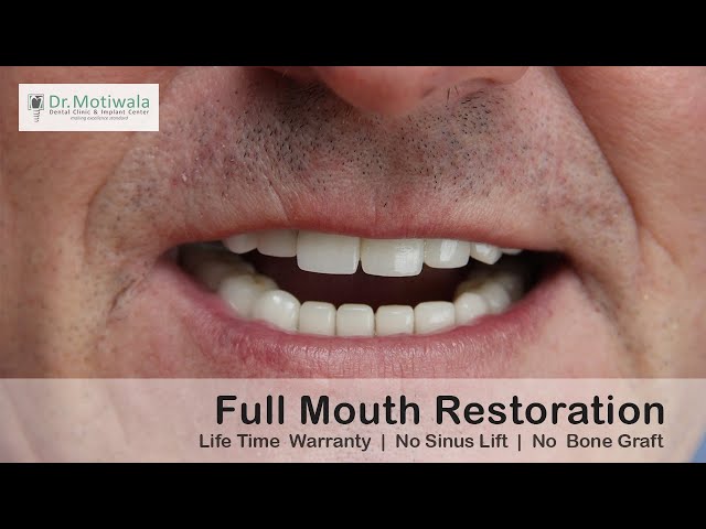 Terry flies from London | Full mouth restoration in India | Immediate Loading One - Piece Implants