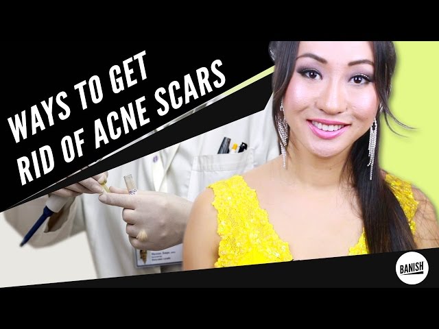 ALTERNATIVE WAYS TO GET RID OF ACNE SCARS