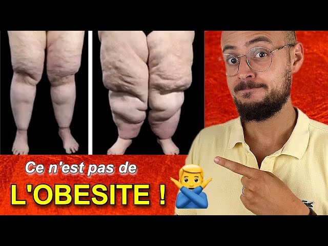 Le LIPOEDEME ou maladie des GROSSES JAMBES !