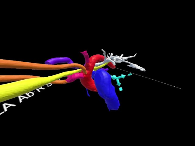 Vascular Rings 4 (Odd) - Left arch with aberrant right subclavian and LPA sling