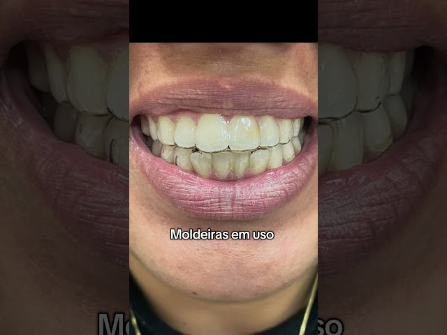 Clareamento dental caseiro. #odontologia #clareamentodentario #medico #aparelhodental #restauração