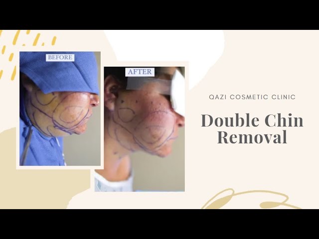 DOUBLE CHIN REMOVAL