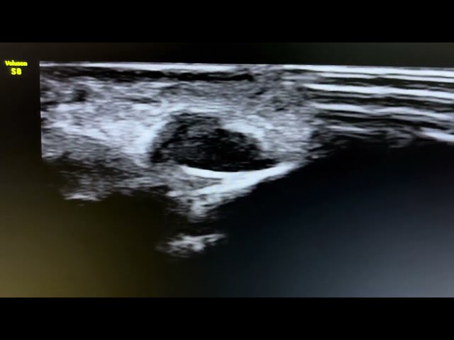 Ultrasound of glomus tumor in finger. See description section for detail