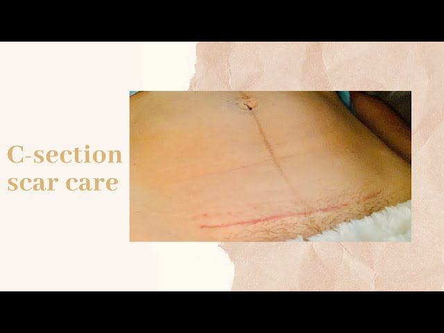 Cesarean Section Scar Care