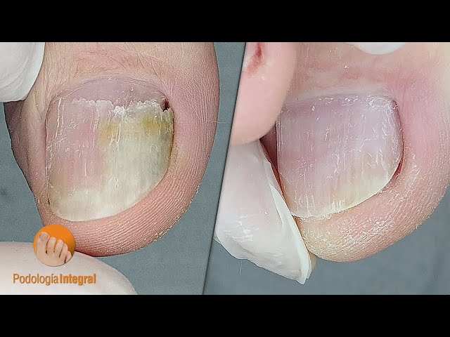 Toenail recovery | Medial lysis | Podological goal achieved! [Podología Integral]