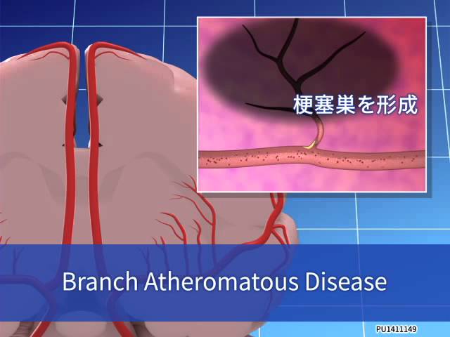 脳小血管病症候群