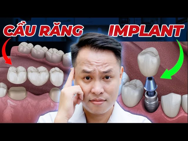 Nên Chọn Cầu Răng Sứ Hay Implant Khi Bị Mất Răng