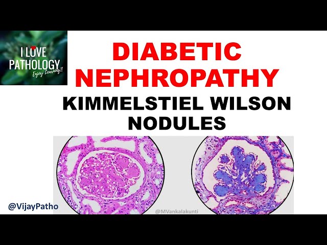 DIABETIC NEPHROPATHY :Pathophysiology & Morphology