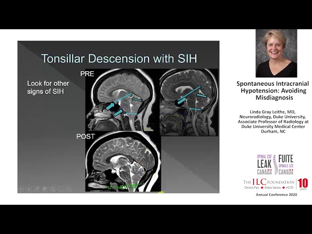 Linda Gray Leithe, MD, Neuroradiology | Spontaneous Intracranial Hypotension: Avoiding Misdiagnosis