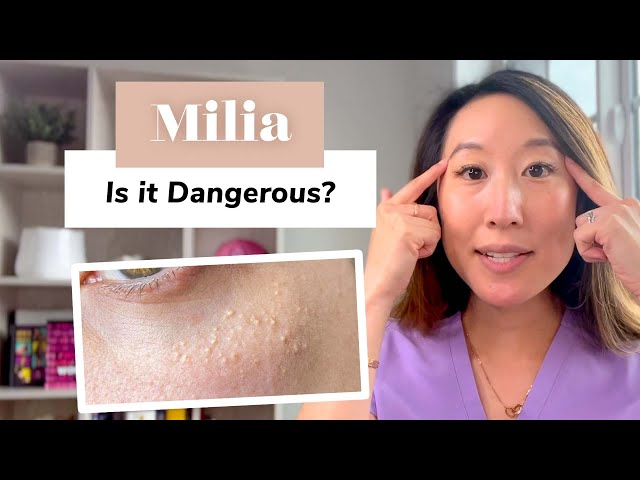 What Is Milia? Removal and Prevention | Dermatologist Guide