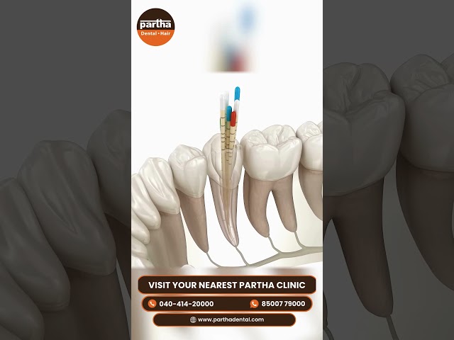 "Say Goodbye to Tooth Pain with Root Canal Treatment!"