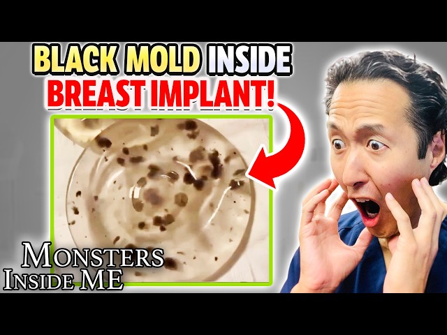 BLACK MOLD in Breast Implants! Plastic Surgeon Reacts to MONSTERS INSIDE ME