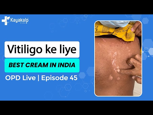 ✅ Best Vitiligo treatment Cream in India | Vitiligo Skin Disease Treatment | 9599794433 | Kayakalp