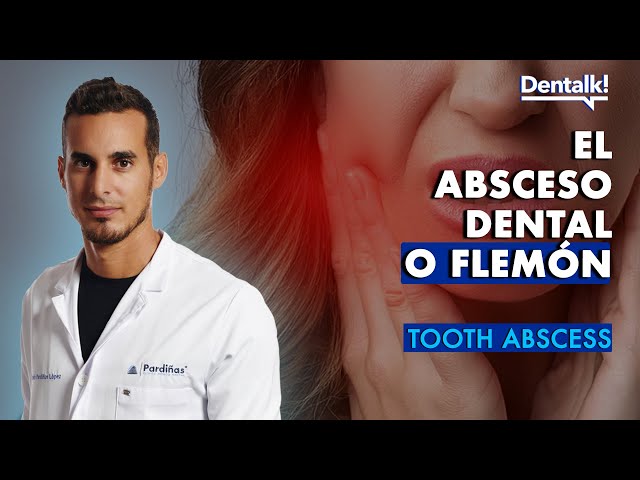 FLEMÓN en una MUELA - Causas, TRATAMIENTO y remedios caseros para el ABSCESO dental | Dentalk! ©