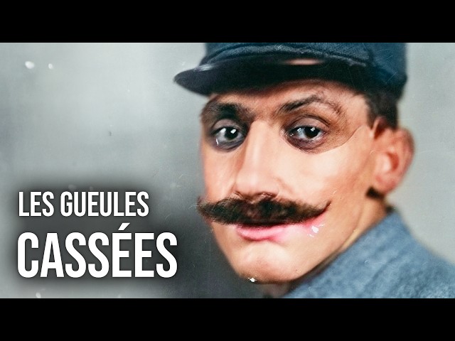 L’histoire tragique des « Gueules Cassées », martyrs de la Grande Guerre - HDG #59