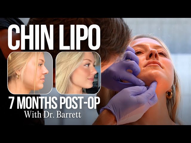 How Chin Lipo Sculpted This Jawline!