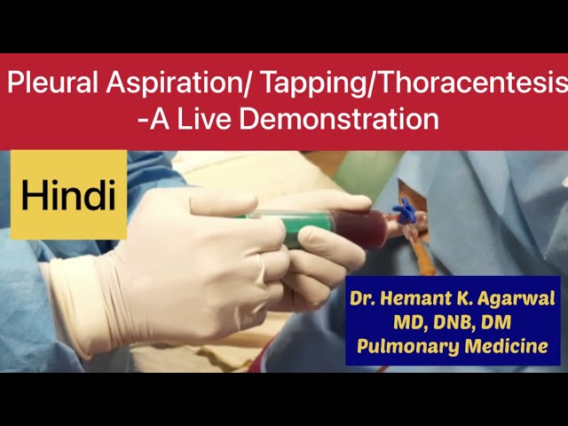 Pleural Aspiration/ Pleural Tapping/ Thoracentesis/ Needle Pleurocentesiss (HINDI)