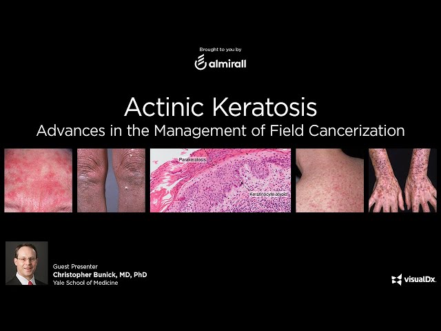 Actinic Keratosis: Advances in the Management of Field Cancerization