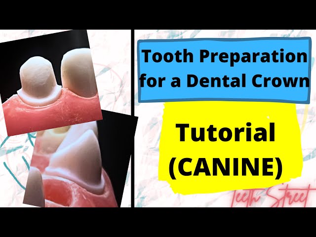 Crown Preparation - Maxillary Canine