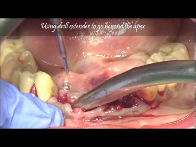 Severe periodontal abscess lower anteriors-Extraction and immedaite dental implants