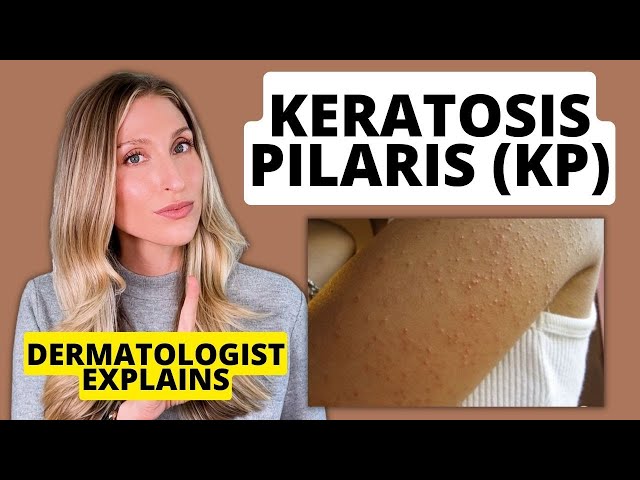 Dermatologist Explains Keratosis Pilaris (KP): Affordable Drugstore Treatments to Try!