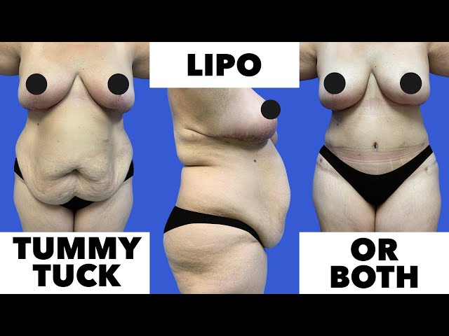 Tummy Tucks vs Liposuction: Which is Right for YOU?