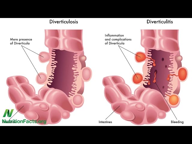 Diverticulosis: When Our Most Common Gut Disorder Hardly Existed